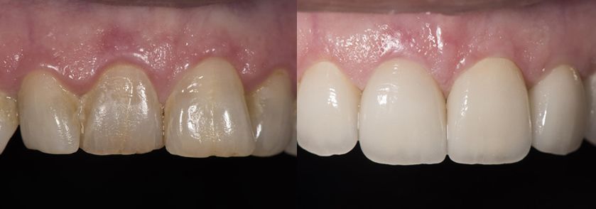 Before and After Porcelain Veneers Case 3