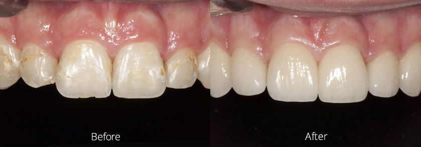 Before and After Complications From Braces Case 1