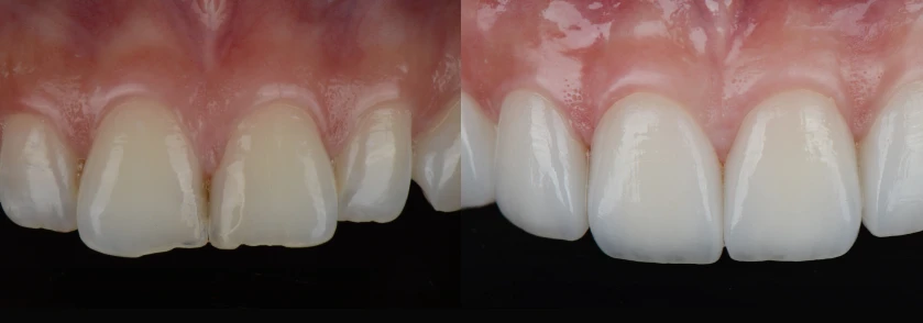 Before and After Porcelain Veneers Case 2
