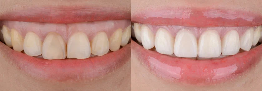 Before and After Porcelain Veneers Case 1