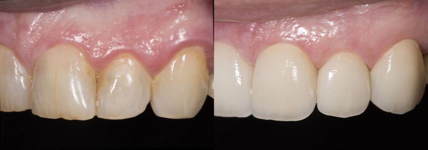 Before and After Porcelain Veneers Case 4