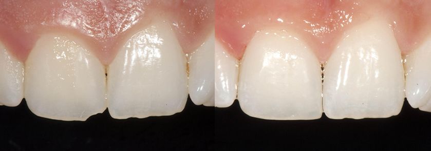 Before and After Dental Bonding Case 1