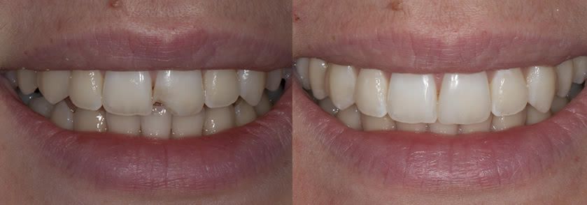 Before and After Dental Fillings Case 1