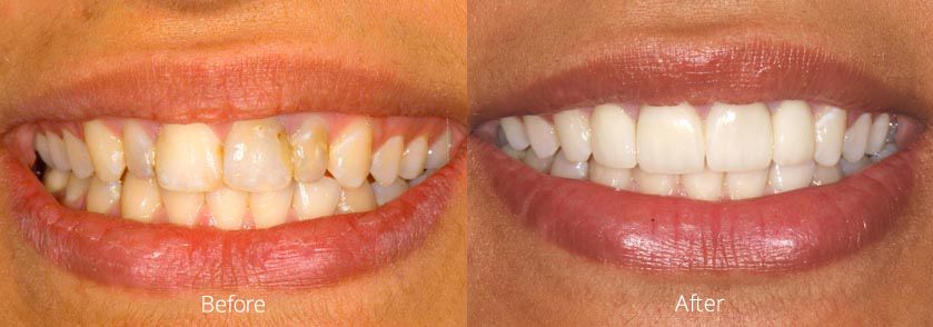 Before and After Full Porcelain Crowns Case 1