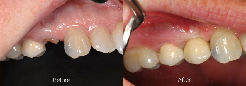 Before and After Dental Implant Case 1