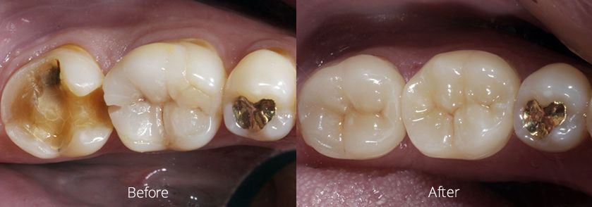 Before and After E4D Case 1