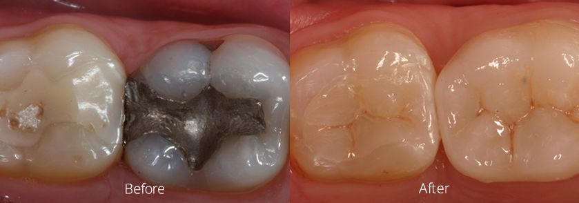 Before and After E4D Case 2
